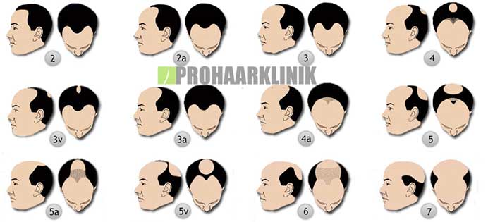 Haarimplantation, Haartransplantation vorher nachher