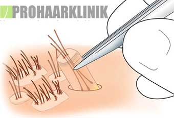 Haartransplantation vorher nachher - Haarverpflanzung Ergebnisse