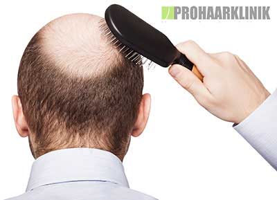 Haartransplantation vorher nachher